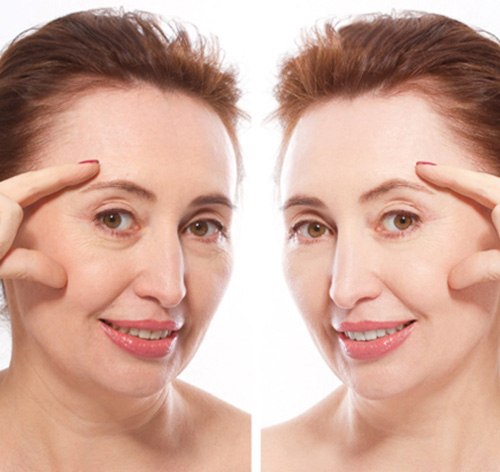 Woman before and after dermal fillers in Camp Hill
