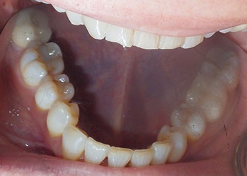 Invisalign Gallery 1 after