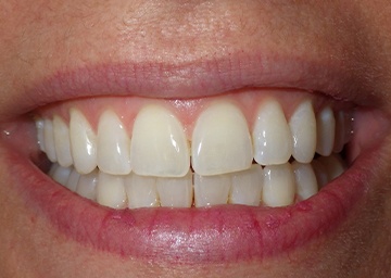Invisalign Gallery 3 after