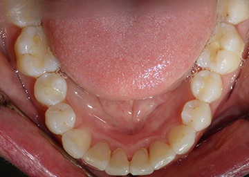 Invisalign Gallery 4 after