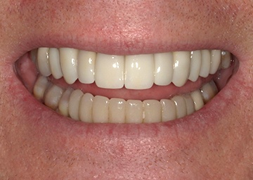 smile makeover gallery 8 after