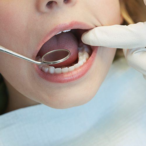 dentist checking childs dental sealants