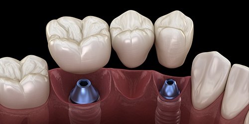 multiple missing teeth implant