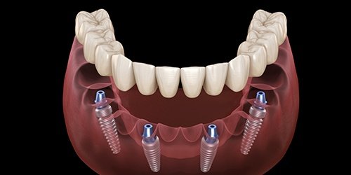 implant on four