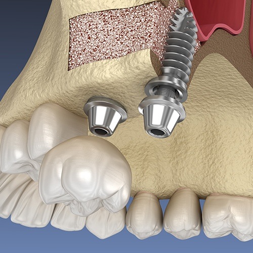Dental Implant Osseointegration