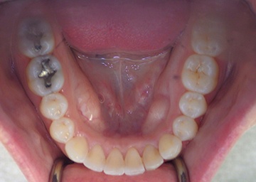 Invisalign Gallery 2 after