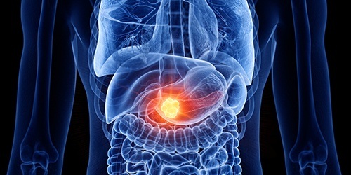illustration of red pancreatic cancer