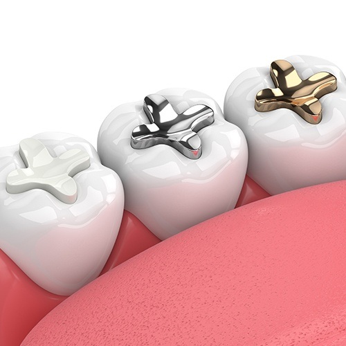 different types of fillings