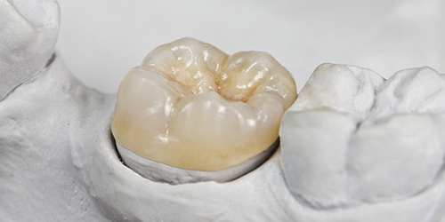 dental crown mockup