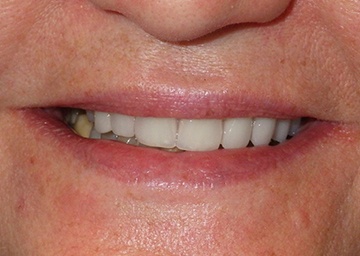smile makeover gallery 10 after