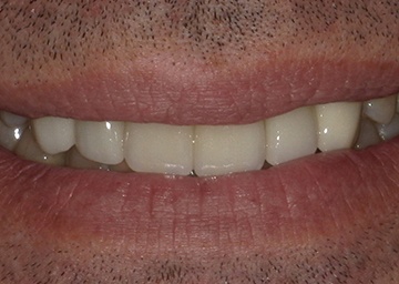 smile makeover gallery 6 after