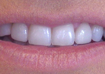 smile makeover gallery 7 after