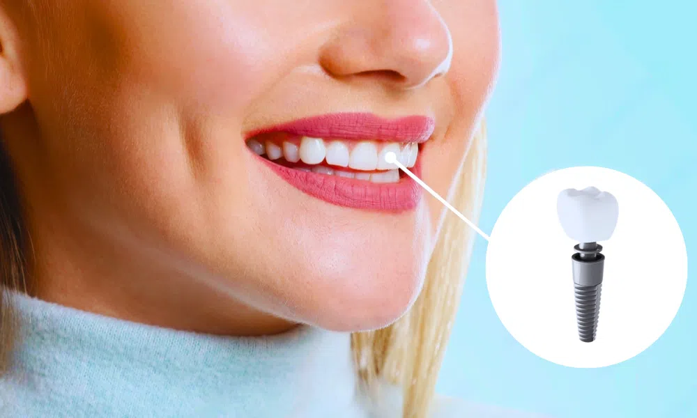 Are You Considering Dental Implants?