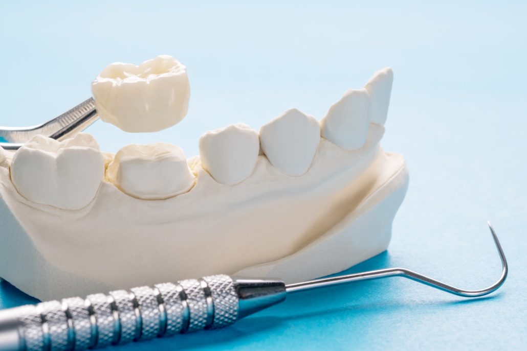 CEREC Crowns: How Long Do They Take to Make?