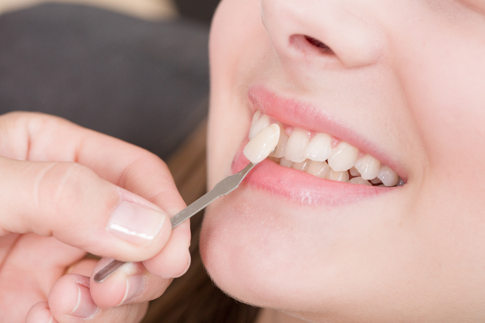 Cavities and Veneers: How to Keep Your Updated Smile Beautiful