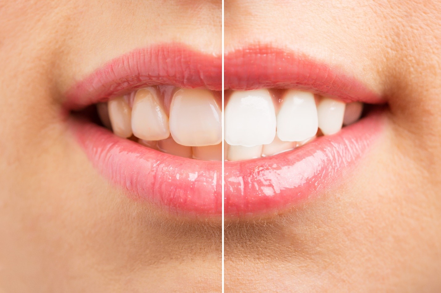 For a Brilliant Smile, Choose Zoom Teeth Whitening in Camp Hill