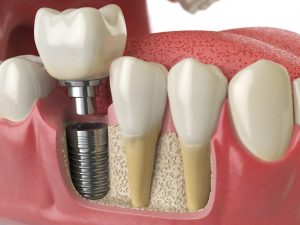 Have a Missing Tooth? Consider Replacing It With a Dental Implant