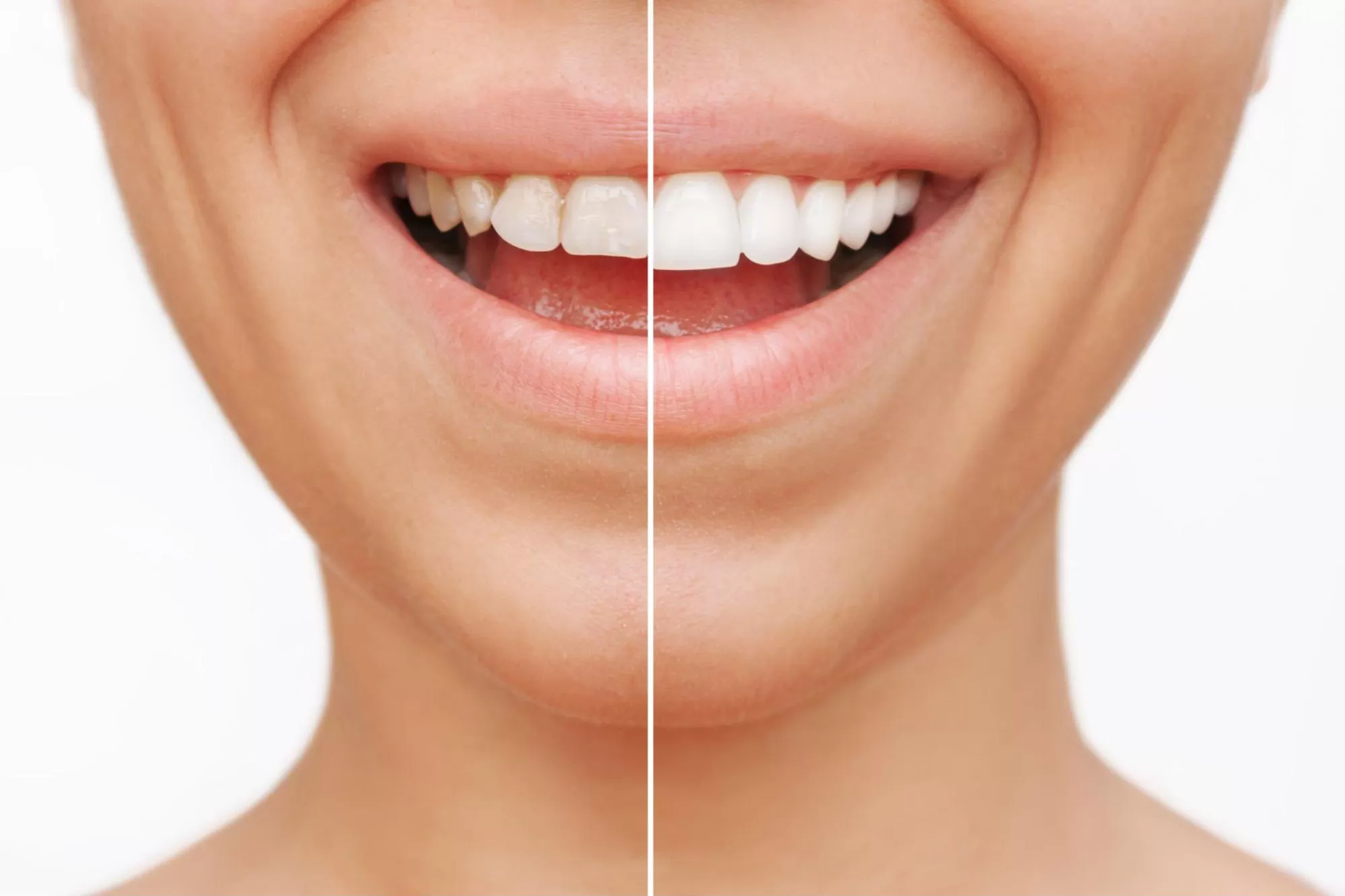Porcelain Veneers or Lumineers: How to Best Transform Your Smile