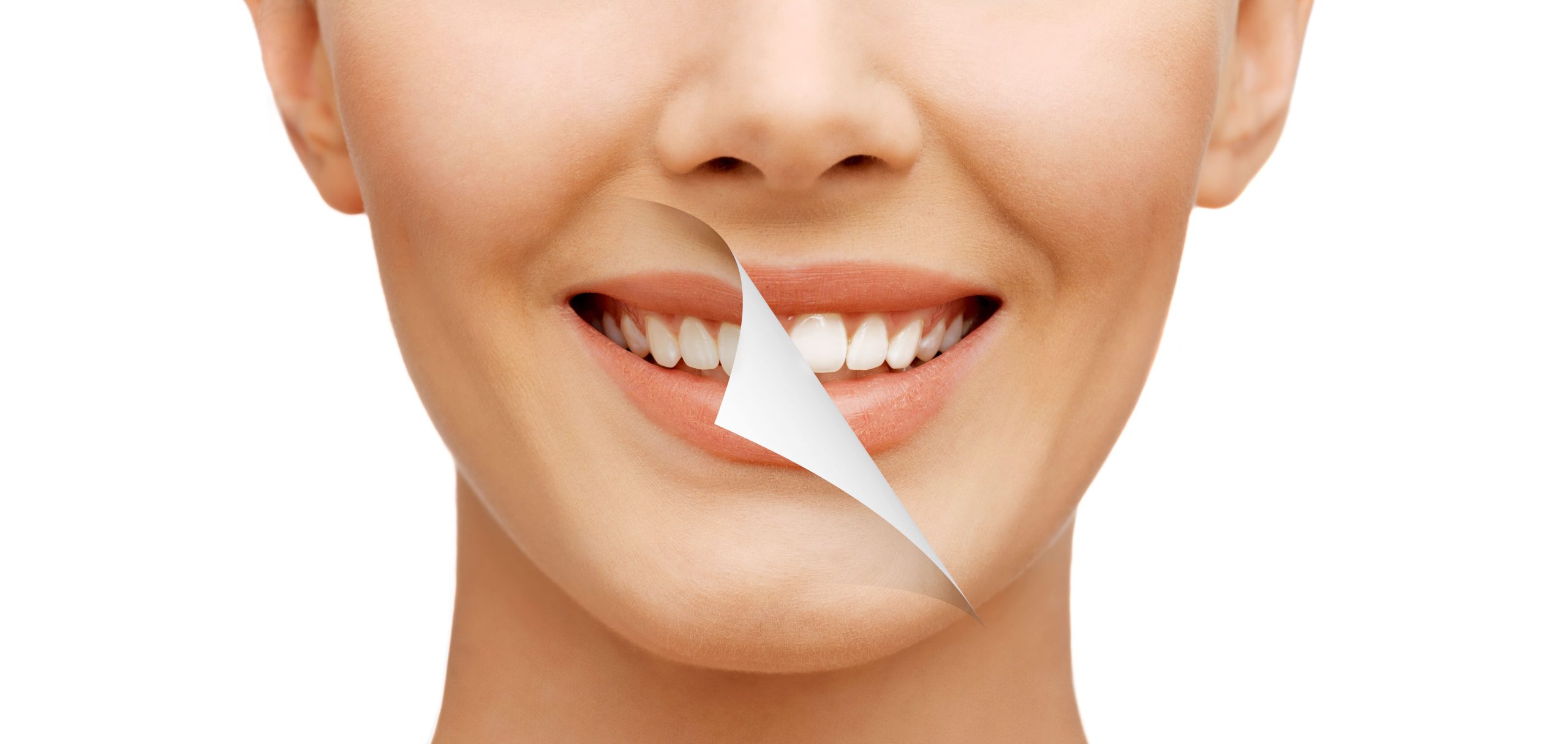 4 Questions to Ask When It Comes to a Smile Makeover