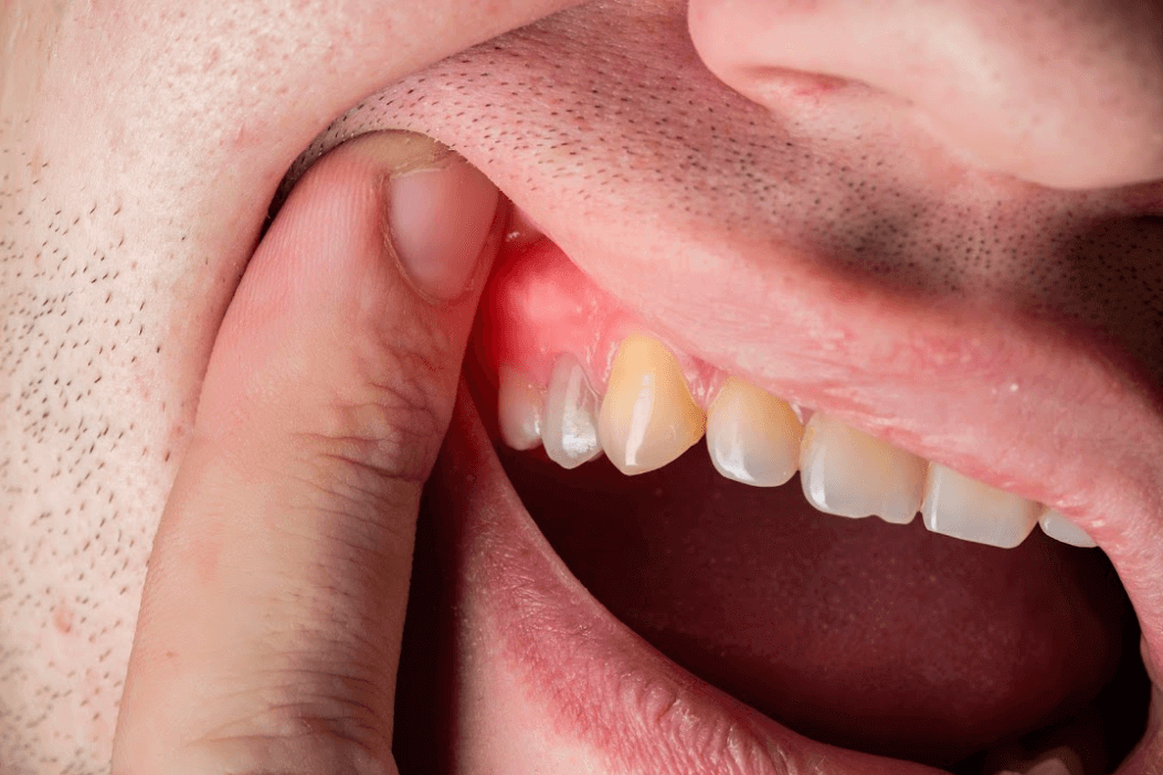 What Is Gum Disease?