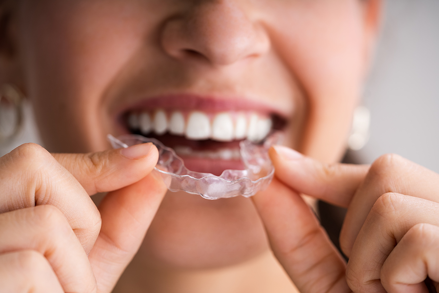 Which Celebrities Have Used Invisalign to Straighten Their Teeth?