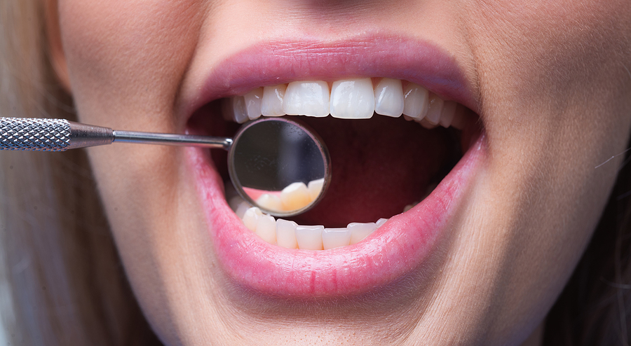 Full Mouth Reconstruction: When Cosmetic and Restorative Dentistry Meet