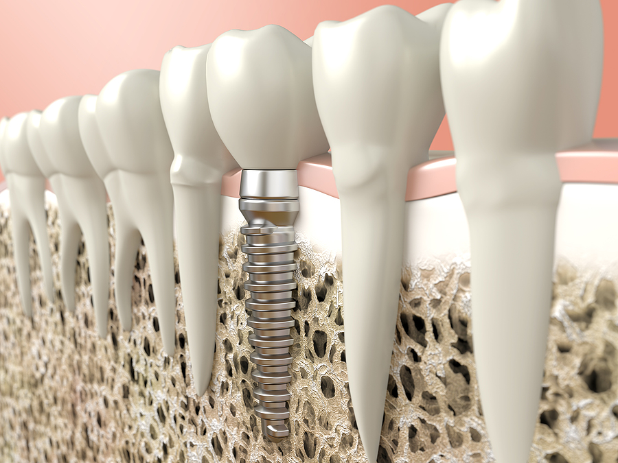 A Complete Guide to Dental Implants: Restoring Your Smile and Confidence