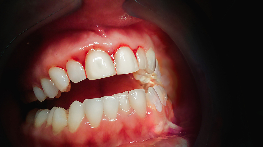 Effective Gum Disease Treatments in Camp Hill, PA for a Healthier Smile